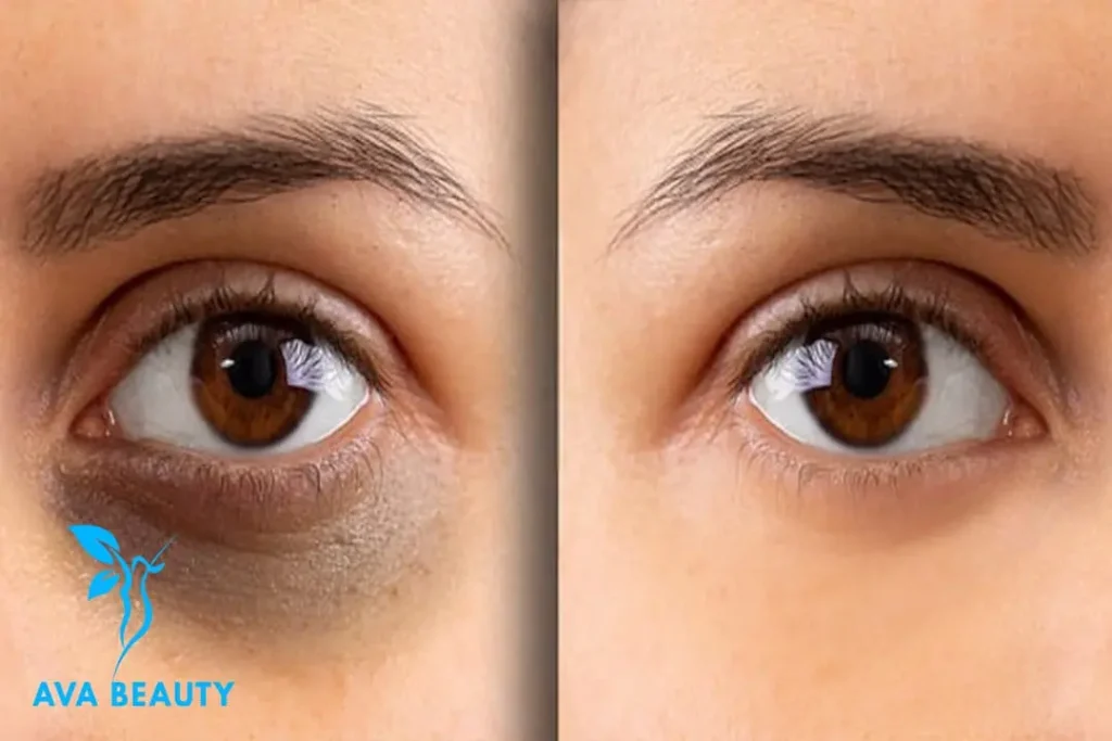 درمان تیرگی دور چشم 1024x683 - علت تیرگی دور چشم و 5 روش درمان آن