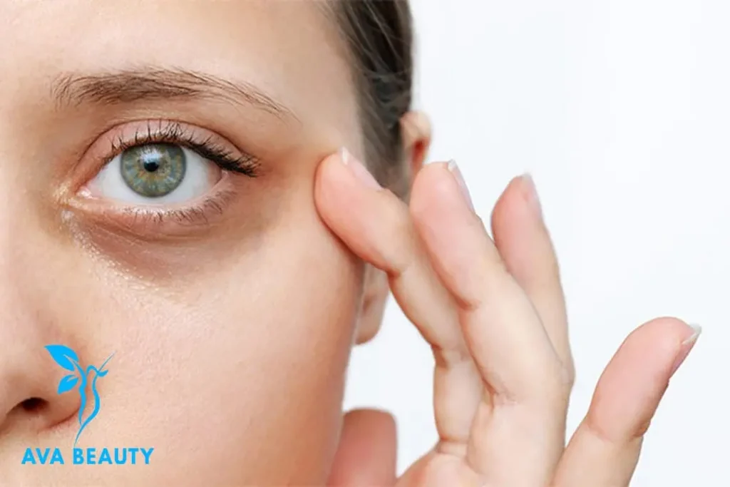 سیاهی دور چشم 1024x683 - علت تیرگی دور چشم و 5 روش درمان آن