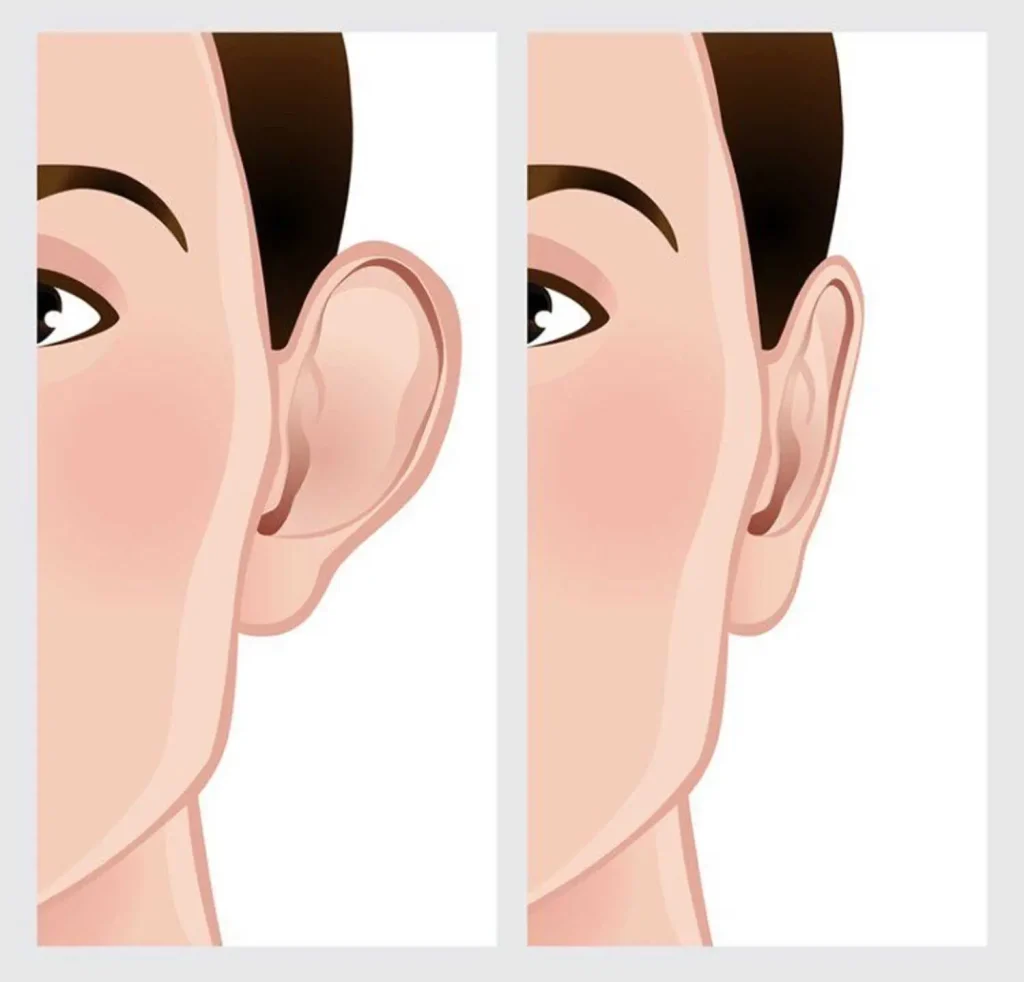 قبل و بعد تصغير الاذن 1024x982 - بهترین سن برای عمل اتوپلاستی گوش